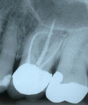 Complex Molar Anatomy